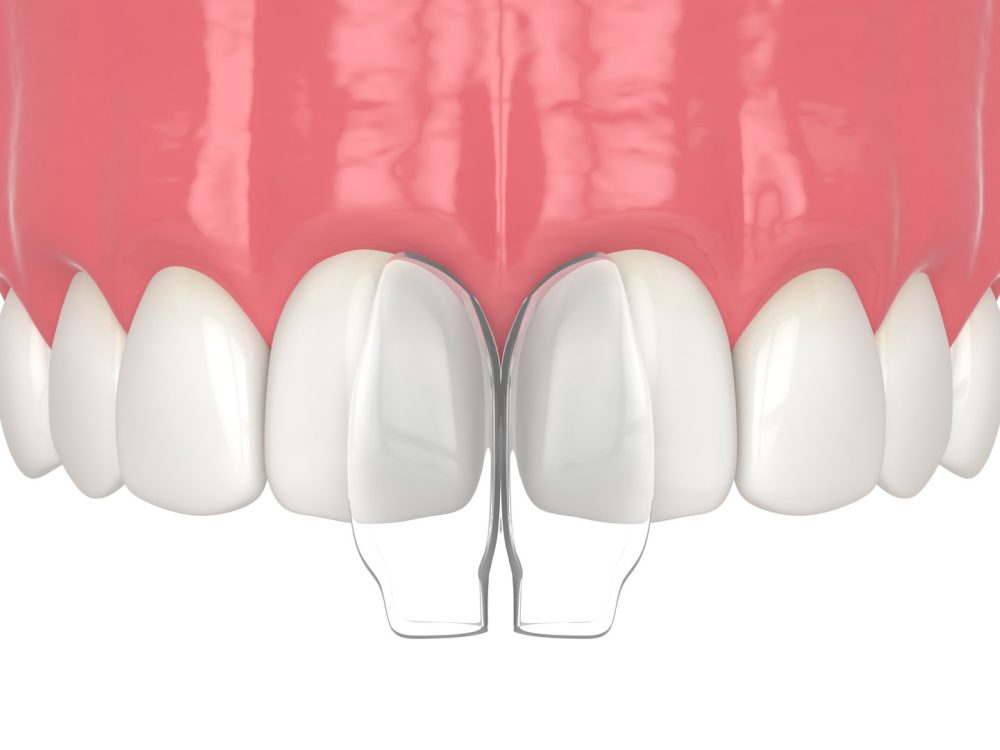 dental-bonding3