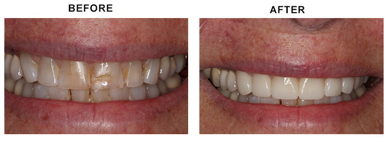 BEFORE AFTER PHOTO