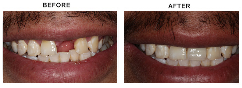 BEFORE AFTER PHOTO
