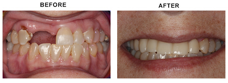 BEFORE AFTER PHOTO