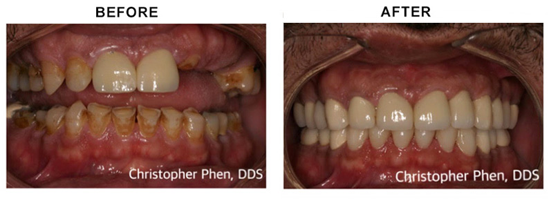 BEFORE AFTER PHOTO