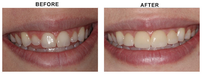 BEFORE AFTER PHOTO
