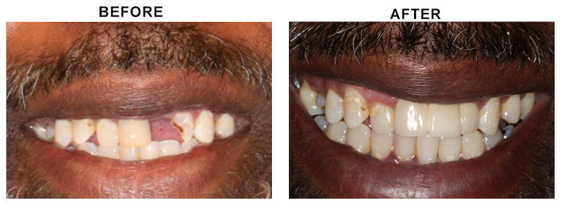 BEFORE AFTER PHOTO